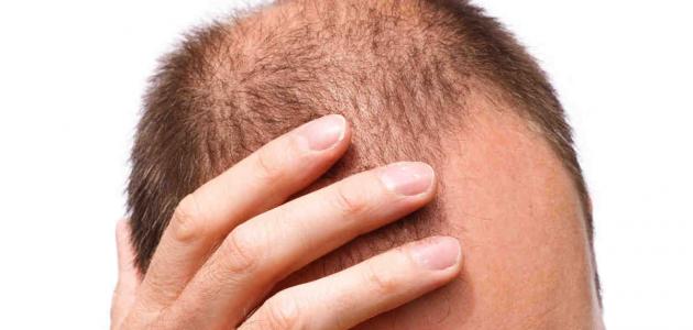 الاثار الجانبية لزراعة الشعر , اضرار زراعة الشعر