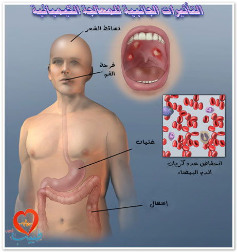 اضرار العلاج الكيماوى , ما هو العلاج الكيميائي واضراره