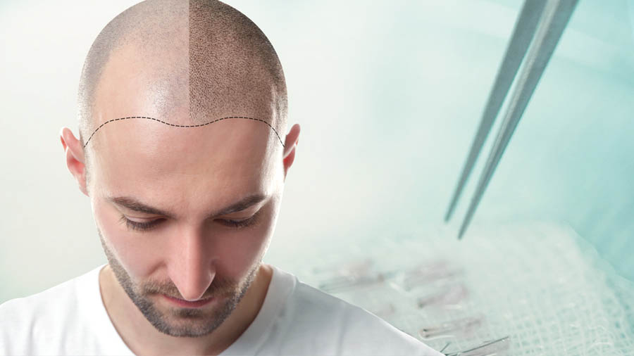 افضل مراكز زراعة الشعر في تركيا , تعرف على احسن مراكز زراعه الشعر بتركيا