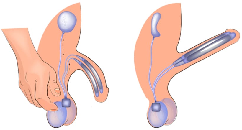 علاج ضعف الانتصاب الخطوة الاولى تبدا من عندك , دواء لضعف انتصاب عند الرجل