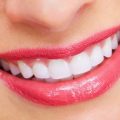 4392 2 اضرار تبييض الاسنان - معلومات عن تبيض الاسنان جميلة