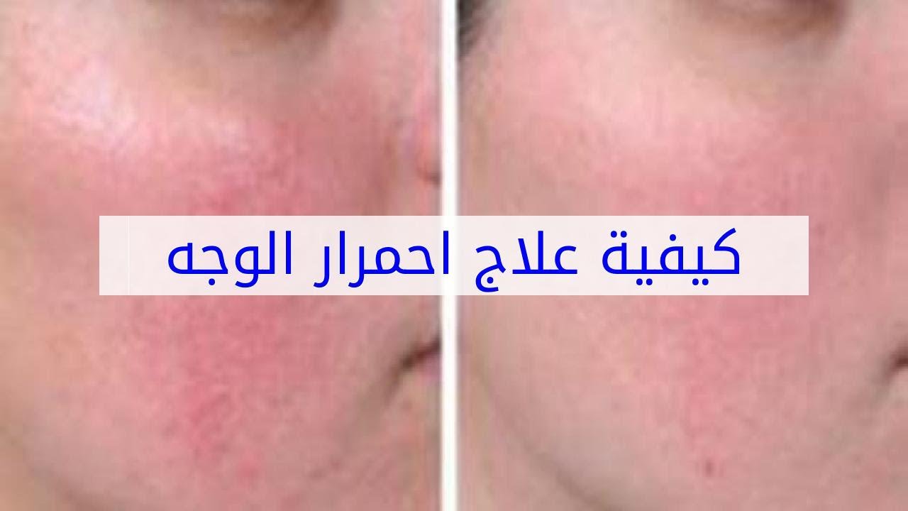 5905 3 علاج احمرار الوجه - وصفات للتخلص من احمرار الوجه U16