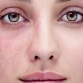 5906 1 علاج حساسية الوجه - الطرق الطبيعيه للتخلص من حساسيه الوجه سلوى سعود