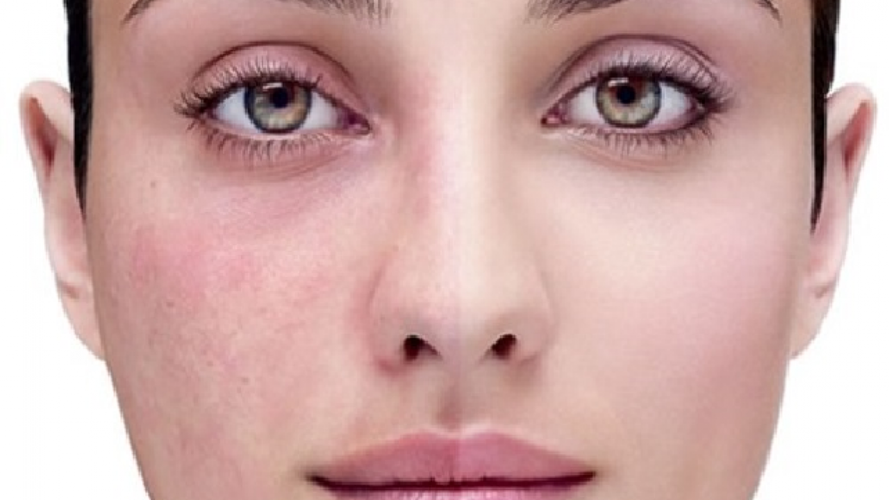 5906 1 علاج حساسية الوجه - الطرق الطبيعيه للتخلص من حساسيه الوجه U16