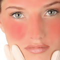 6595 1 علاج حروق الوجه - كيفيه علاج الحروق بالوصفات الطبيعيه U16
