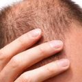 4472 3 الاثار الجانبية لزراعة الشعر - اضرار زراعة الشعر حنين محمد