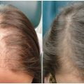 15915 1 الخلايا الجذعية للشعر ، علاج تساقط الشعر بالخلايا الجذعية لولو الامورة